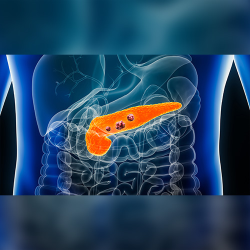 IN THE NEWS: Risks of Pancreatic Cancer